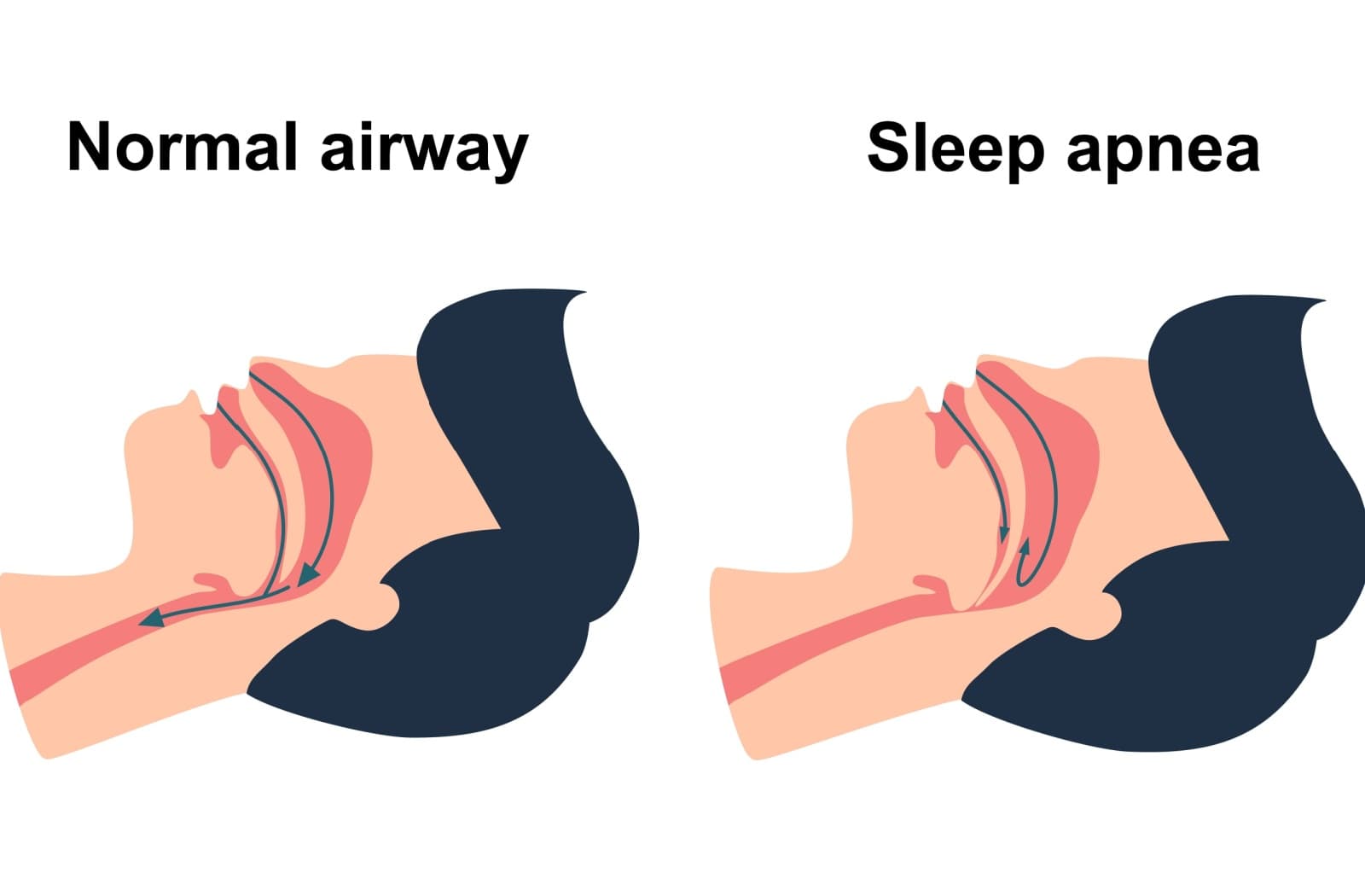 An illustration showing the difference between a normal airway and sleep apnea.