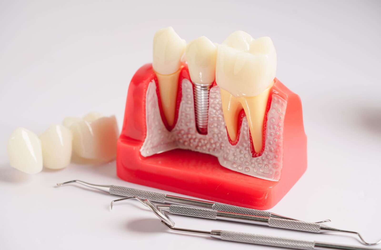 A model of a dental implant is on display with the screw and the crown visible. Some extra crowns are to the side.