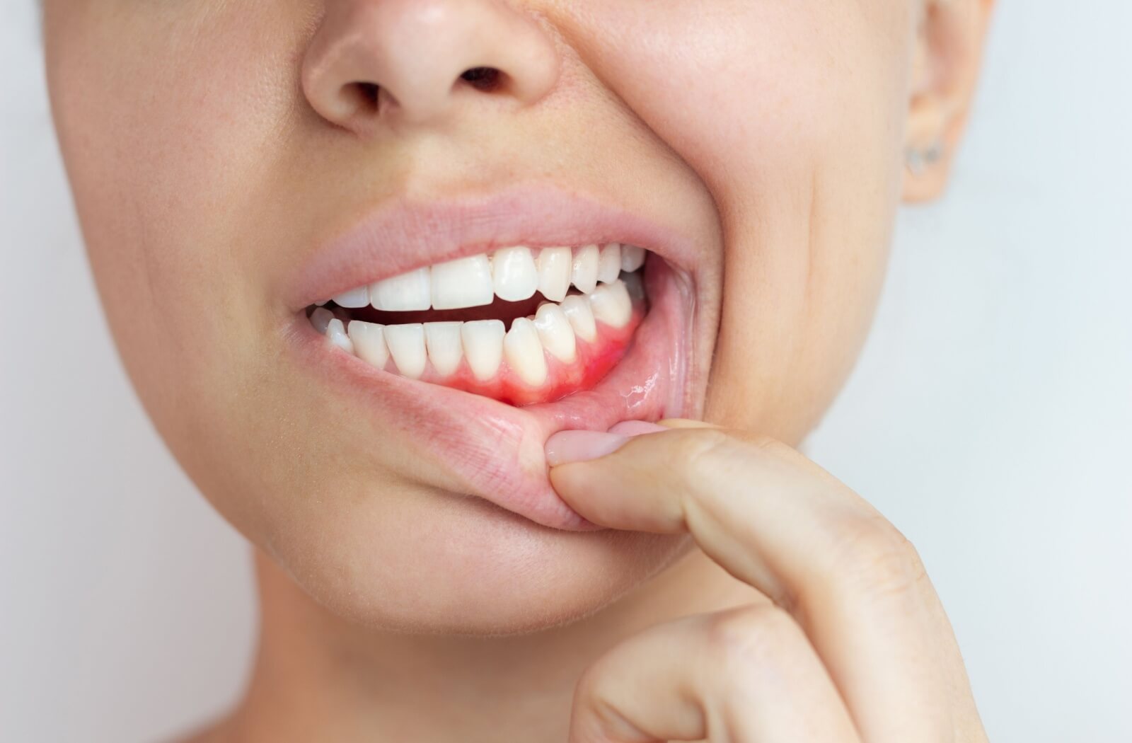 Close-up of a person pulling down their lower lip to reveal red, inflamed gums, indicating possible gingivitis or gum irritation.