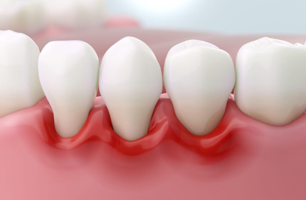 3D illustration showing a close-up of teeth with red, inflamed gums, depicting the effects of gum disease.