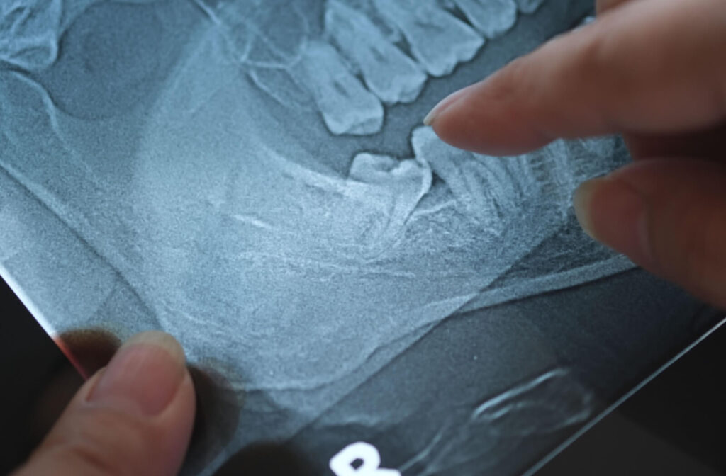 A close-up of a dental X-ray showing impacted wisdom teeth, with a hand pointing to the affected area.