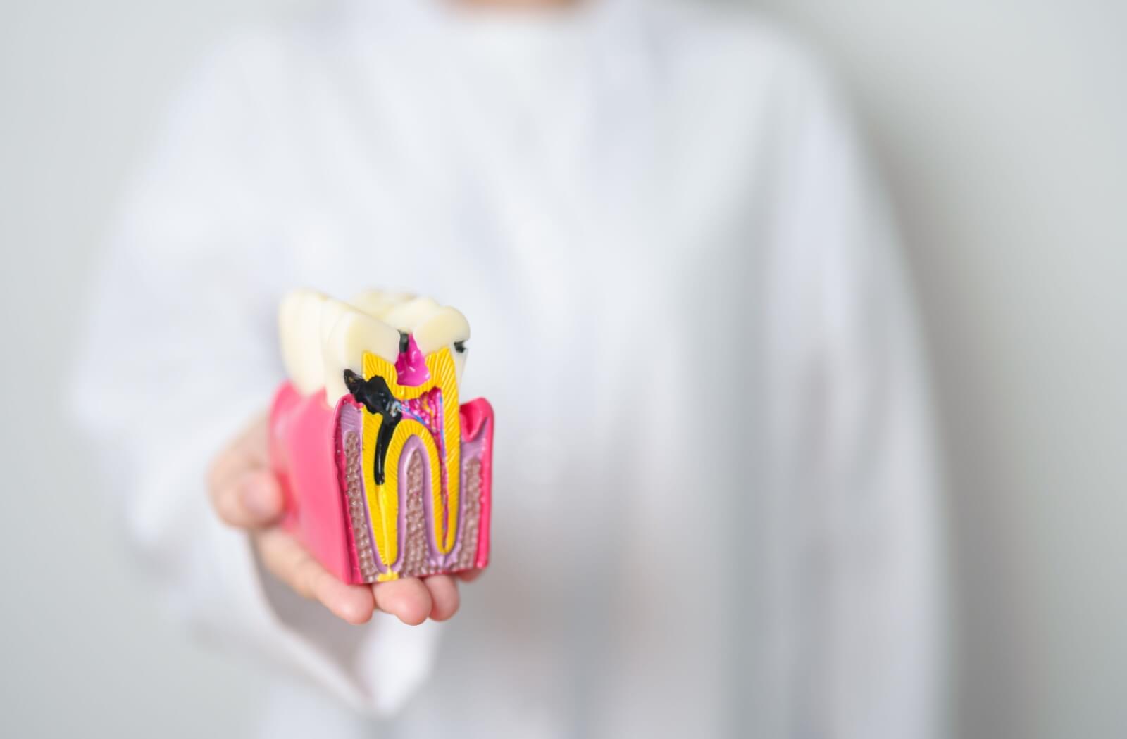 A healthcare professional holding an anatomical dental model showing the internal structure of a tooth and signs of a cavity.